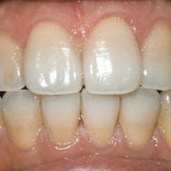 Ronald E Hawk, DDS - Before Tooth Whitening