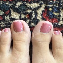 Uneven nails and no exfoliation Uneven nails and no exfoliation