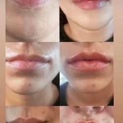 J W Aesthetic - Lip fillers