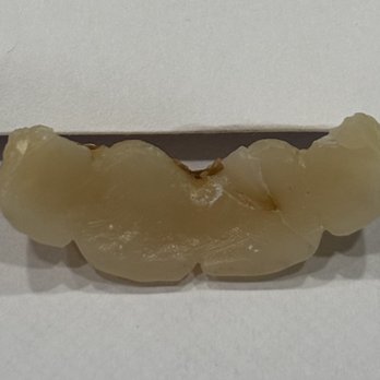 Access Dental Care - Back crowns - Cosmetic Dentists Near Me - Laurel, Maryland Access Dental Care - Back crowns - Cosmetic Dentists Near Me - Laurel, Maryland