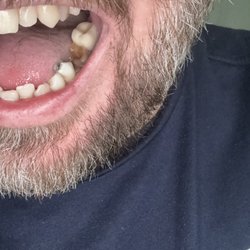 Pony Express Dental & Orthodontics of Eagle Mountain - Failed dental work. Go anywhere else