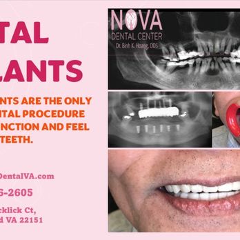 NOVA Dental Center - Dental implants - Oral Surgeons Near Me - Springfield, Virginia NOVA Dental Center - Dental implants - Oral Surgeons Near Me - Springfield, Virginia