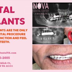 NOVA Dental Center - Dental implants