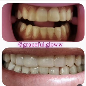 Graceful Glow By Lizzy - Teeth Whitening Near Me - Bellaire, Texas Graceful Glow By Lizzy - Teeth Whitening Near Me - Bellaire, Texas