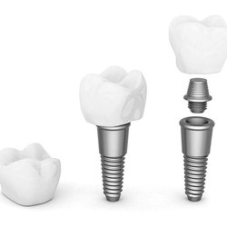 Ohana Dental Implant Centers - Montrose - Tooth Replacement