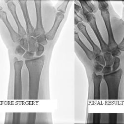 Tri-Valley Orthopedic Specialists - These are my before surgery and final result x rays with Dr. Horner as my surgeon.