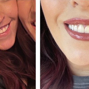 SkinSpirit - Before and after one appointment - Skin Care Near Me - Newport Beach, California SkinSpirit - Before and after one appointment - Skin Care Near Me - Newport Beach, California