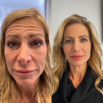 Dosed By Zaza - Full face rejuvenation - Medical Spas Near Me - Houston, Texas Dosed By Zaza - Full face rejuvenation - Medical Spas Near Me - Houston, Texas