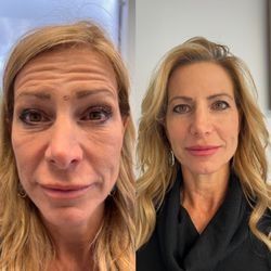 Dosed By Zaza - Full face rejuvenation
