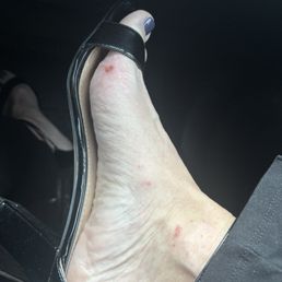 Skin removed from my foot and ankle from a pedicure at SOHO in Farragut, TN. Skin removed from my foot and ankle from a pedicure at SOHO in Farragut, TN.