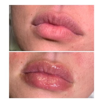 Euphoria Esthetics - Hyaluron Pen Filler - Skin Care Near Me - Sherrill, New York