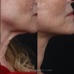 Mid-face Facelift and Myellevate procedure