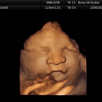 Bump Life 4D Ultrasound Studio - Big yawn - Ultrasound Imaging Centers Near Me - Madison, Alabama Bump Life 4D Ultrasound Studio - Big yawn - Ultrasound Imaging Centers Near Me - Madison, Alabama