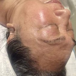 Beauty Unlimited - Skin tag / mole removal. After
