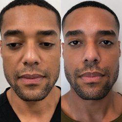 Ever Body - Logan Circle - Sculptra treatment Left = before  Right = after