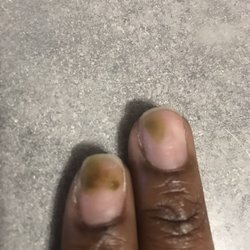 Nc Nails - Fungus on nails
