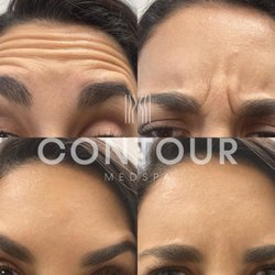 Contour Med Spa - Patient treated with Jeuveau® @ Contour Medspa