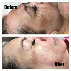 HFskin Beauty Bar - Facial Dermaplaning