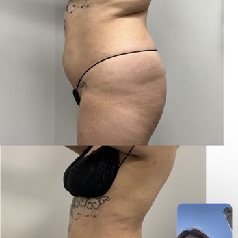 Vitality Medical Center - 1 month post op - Medical Spas Near Me - Glendale, California