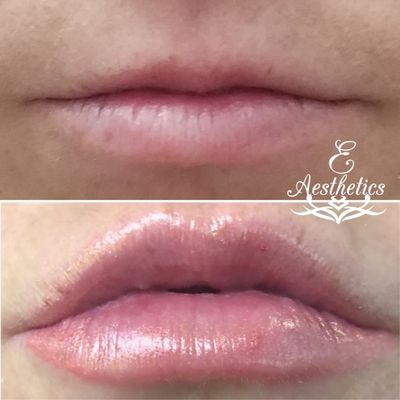Filler - Before and After Photos of our Filler Patients Filler - Before and After Photos of our Filler Patients