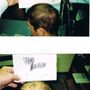 Tampa Bay Hair Restoration