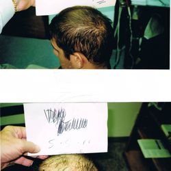 Tampa Bay Hair Restoration