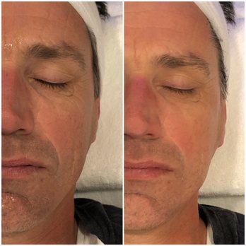 Lightbeauty Cryo - Cryo facial.. after just one! - Cryotherapy Near Me - Birmingham, Michigan Lightbeauty Cryo - Cryo facial.. after just one! - Cryotherapy Near Me - Birmingham, Michigan