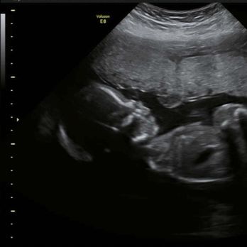 Next Generation Prenatal Imaging - Ultrasound Imaging Centers Near Me - Elk Grove, California Next Generation Prenatal Imaging - Ultrasound Imaging Centers Near Me - Elk Grove, California