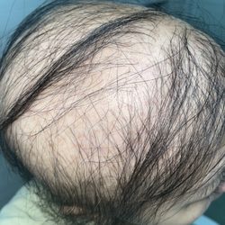 Glamour Hair Design - Came for hot oil.After 5 wks of treatmen, I had drastic hair loss. From healthy hair to losing all my hair. Diagnosis was telogen effluvium.