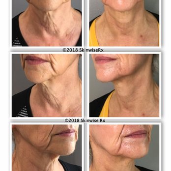 Skinwise Rx - Radiofrequency microneedling encourages collagen growth which tights skin on the neck, reduces wrinkles, and defines jawline. - Medical Spas Near Me - Portland, Oregon Skinwise Rx - Radiofrequency microneedling encourages collagen growth which tights skin on the neck, reduces wrinkles, and defines jawline. - Medical Spas Near Me - Portland, Oregon