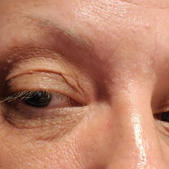 Renew Medical Spa - My skin is not normally crepey - Medical Spas Near Me - Medford, Oregon