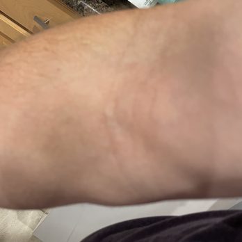 CSL Plasma - This is the "slight bruising" and why I couldn't donate today. - Blood & Plasma Donation Centers Near Me - Gilbert, Arizona
