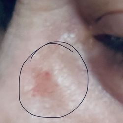 Beauty & Beast Studio - Right side of nose lacerated and bruising