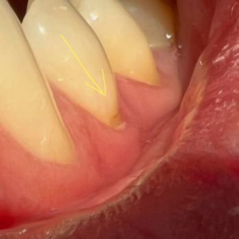 Inspired Dental - Enamel starts to break now - General Dentistry Near Me - Las Vegas, Nevada Inspired Dental - Enamel starts to break now - General Dentistry Near Me - Las Vegas, Nevada