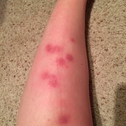 Flea bites. Very itchy.. My skin stayed at least for a week like this.. Disgusting. I should've sue them about this! Flea bites. Very itchy.. My skin stayed at least for a week like this.. Disgusting. I should've sue them about this!