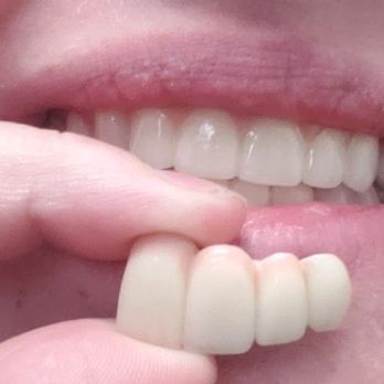 Carson Dental Designs - Look at how much nicer the implants in my mouth our compared to the giant ones are that fell out from a different practice. I am so pleased - General Dentistry Near Me - Carson City, Nevada