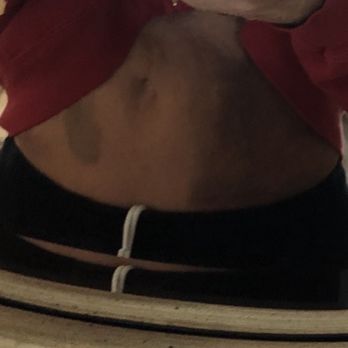 Beauty By Buford - Front view of bruise from the bleed. - Cosmetic Surgeons Near Me - Lone Tree, Colorado