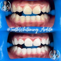 Teeth Whitening By Ardita