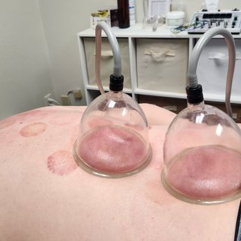 BodyMind AcuBalance - Acupuncture Near Me - Garden Grove, California BodyMind AcuBalance - Acupuncture Near Me - Garden Grove, California