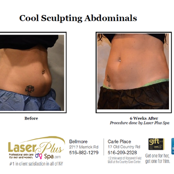 Laser Plus Spa - Actual client - Medical Spas Near Me - Bellmore, New York Laser Plus Spa - Actual client - Medical Spas Near Me - Bellmore, New York