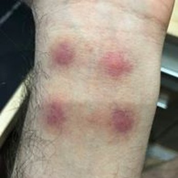 Motel 6 - "Mosquito bites" as claimed by the manager - two days after the stay - Hotels Near Me - Seekonk, Massachusetts