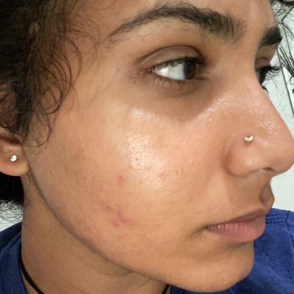 Bare Electrolysis - Hair Removal Near Me - San Diego, California
