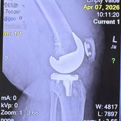 Christopher Woodson, MD - Total knee replacement