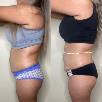 Sweet Body - Body Contouring Near Me - Bedford, Texas Sweet Body - Body Contouring Near Me - Bedford, Texas