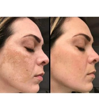 Keller Med Spa & Laser - Advatx - Medical Spas Near Me - Camas, Washington Keller Med Spa & Laser - Advatx - Medical Spas Near Me - Camas, Washington