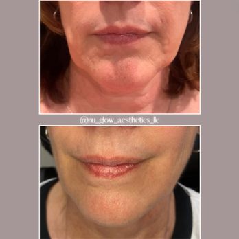 Nu Glow Aesthetics - Lower face tox and filler (1 syringe) result....smooth and lifted! - Medical Spas Near Me - Aliquippa, Pennsylvania Nu Glow Aesthetics - Lower face tox and filler (1 syringe) result....smooth and lifted! - Medical Spas Near Me - Aliquippa, Pennsylvania