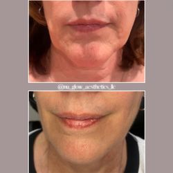 Nu Glow Aesthetics - Lower face tox and filler (1 syringe) result....smooth and lifted!