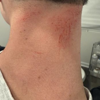Great Clips - Central Park - Chemical burn from a perm. - Hair Salons Near Me - Fredericksburg, Virginia Great Clips - Central Park - Chemical burn from a perm. - Hair Salons Near Me - Fredericksburg, Virginia