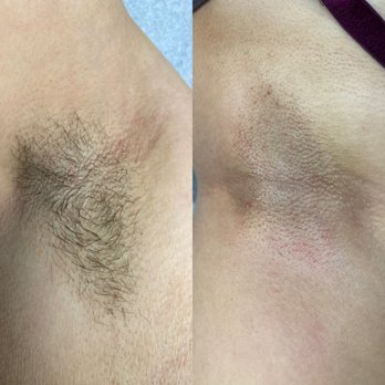 Frost Flower Wax Studio - Underarm wax. Hairs need to be at least 1/4 inch length (similar to a rice grain) in order for the wax to fully grab. - Waxing Near Me - San Jose, California Frost Flower Wax Studio - Underarm wax. Hairs need to be at least 1/4 inch length (similar to a rice grain) in order for the wax to fully grab. - Waxing Near Me - San Jose, California