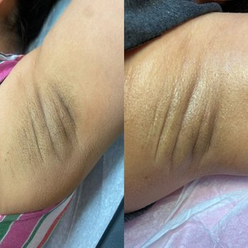Anew Luxury - Before & After Intimate Lightening - Waxing Near Me - Carson, California Anew Luxury - Before & After Intimate Lightening - Waxing Near Me - Carson, California